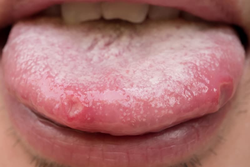 A través de Refrescante pago Llagas lengua, ¿Por qué se producen y cómo curarlas? | Aragonia